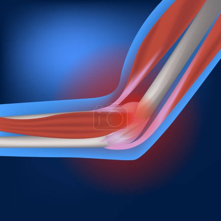 Illustration for Epicondylitis of the elbow joint. inflammatory and degenerative lesion of soft tissues. Orthopedic pathology. Vector illustration - Royalty Free Image