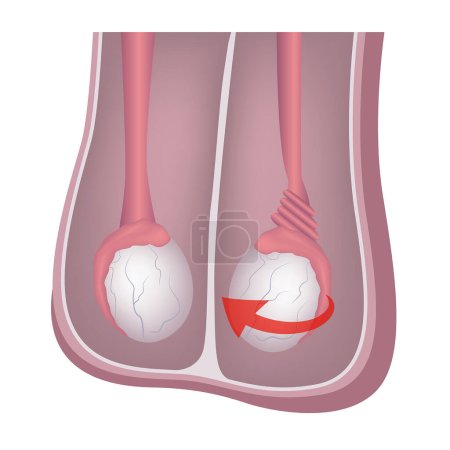 Ilustración de Torsión testicular. Diagrama con la anatomía de los órganos genitales masculinos. Cartel médico. Ilustración vectorial - Imagen libre de derechos