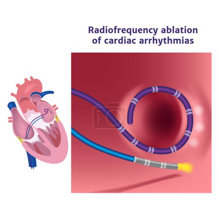 Illustration for Radiofrequency catheter ablation of the heart. Illustration with a surgical procedure. Medical poster. Vector illustration - Royalty Free Image