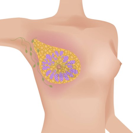Téléchargez les illustrations : Anatomie des glandes mammaires d'une femme. Corps réaliste avec des seins. Affiche médicale. Illustration vectorielle - en licence libre de droit