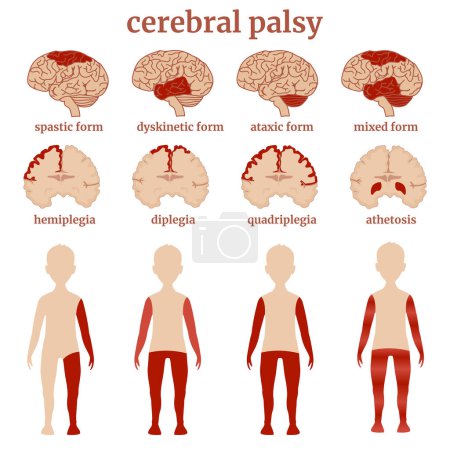 Diagrama que indica los tipos de parálisis cerebral utilizando el ejemplo de dibujos del cerebro y una figura humana. Cartel médico conceptual. Ilustración vectorial