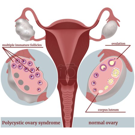 Illustration for Polycystic ovary syndrome. Infographic showing the disease. Undeveloped follicles. Sectioned ovaries. Medical poster, vector illustration - Royalty Free Image