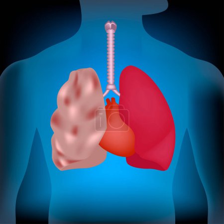 Emphysème des poumons. Illustration au néon. Organes sur le fond du torse. Illustration vectorielle