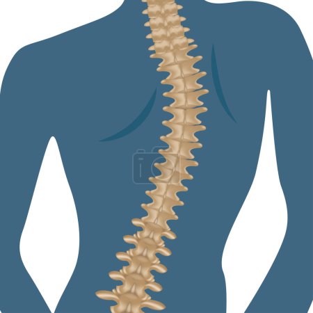 Ilustración de Osteocondrosis de la columna vertebral. Silueta de una mujer con la espalda curvada. Ilustración vectorial - Imagen libre de derechos