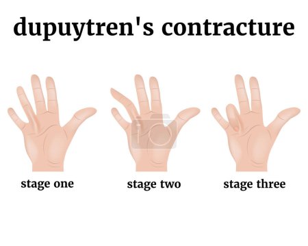 Dupuytren's contracture. 3 stages of development of the disease. Injury to the tendons of the hand, palm. Medical poster with description, vector illustration