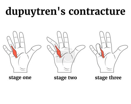 Dupuytren's contracture. 3 stages of development of the disease. Injury to the tendons of the hand, palm. Medical poster with description, vector illustration