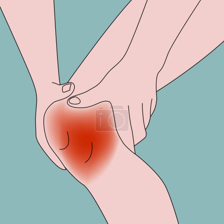 Ilustración de Cartel con la rodilla inflamada. Un hombre con las manos en la pierna. ilustración plana médica - Imagen libre de derechos