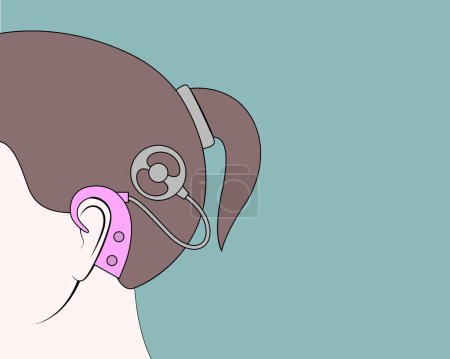 Cochlea-Implantat auf dem Kopf eines Mädchens. Medizinischer Hintergrund oder Plakat. Vektorflache Illustration