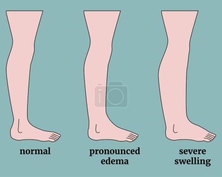 Illustration for Stages of human leg edema. Medical background or poster. Vector flat illustration - Royalty Free Image