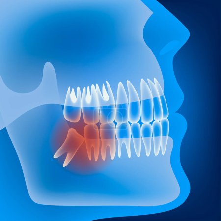 Illustration for Incorrect wisdom tooth growth. Light profile. Medical poster. Verctor illustration - Royalty Free Image