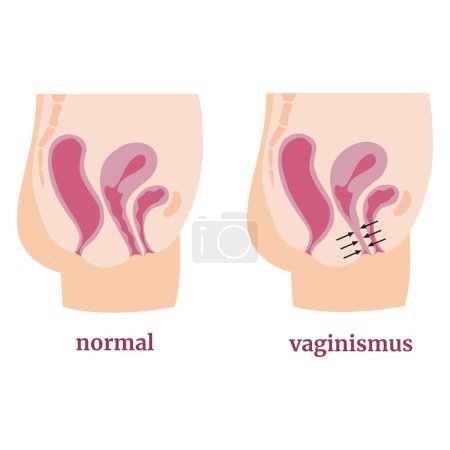 Illustration for Vaginismus. Spasm of the muscles of the vagina and pelvic floor. Medical infographic, poster, tutorial. Vector illustration - Royalty Free Image