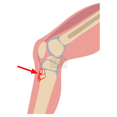Illustration for Osgood-Schlatter disease. Destruction of the tibial nucleus. Human leg on the side. Medical poster, infographics. Vector illustration - Royalty Free Image