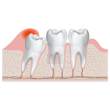Illustration for Incorrectly growing wisdom tooth. Realistic medical illustration, poster, infographic. Vector illustration - Royalty Free Image