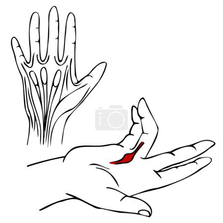 Concept for medical design. Diseases of the palms. Dupuytren's contracture. Drawing with simple black lines. Isolated vector illustration