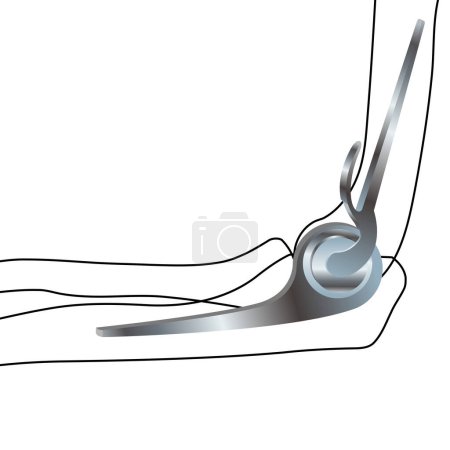 Endoprosthetics, elbow joint prosthesis. Vector illustration. Medical poster