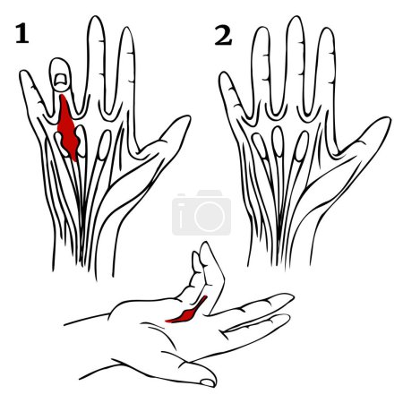 La contractura de Dupuytren. Infografías de las palmas antes y después de la cirugía. cartel médico minimalista