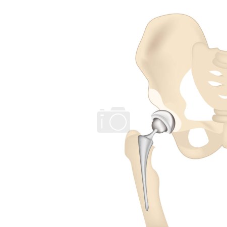Endoprothèses, prothèses articulaires de la hanche. Illustration vectorielle 3D. Affiche médicale
