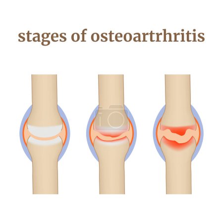 Stages of osteoarthrosis, destruction of joints and cartilage disease. Medical infographics, poster. Vector illustration