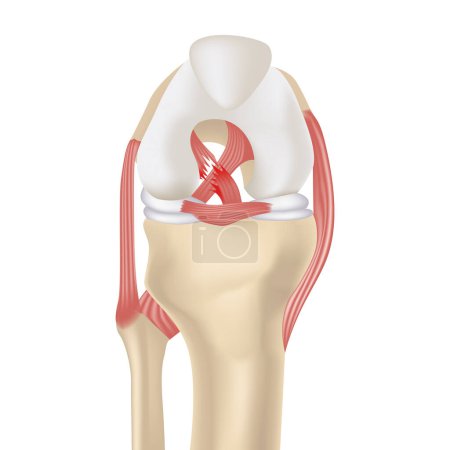 Illustration for Cruciate ligament rupture. Realistic rendering of the knee joint, drawer syndrome. Medical poster. Vector illustration - Royalty Free Image