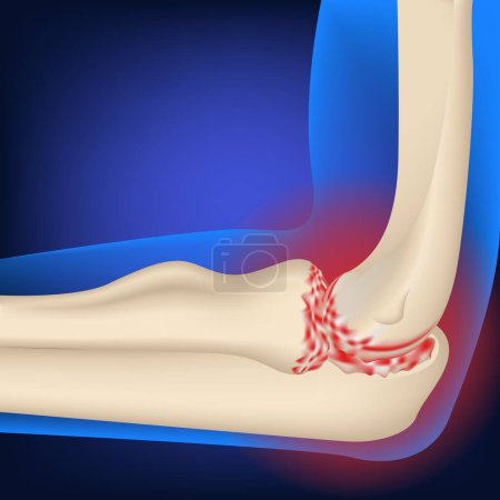 Illustration for Arthrosis of the elbow joint. Illustration of hand bones on a neon blue background. Medical poster. Vector illustration - Royalty Free Image