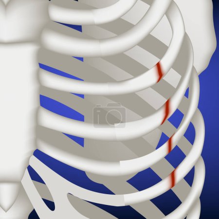 Illustration for Broken ribs on a blue background, close-up. Medical poster, vector isolated illustration - Royalty Free Image
