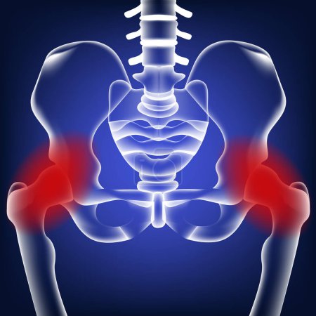 Medizinischer, blauer, neonfarbener Hintergrund mit menschlichen Beckenknochen. Osteoporose. Medizinisches Poster