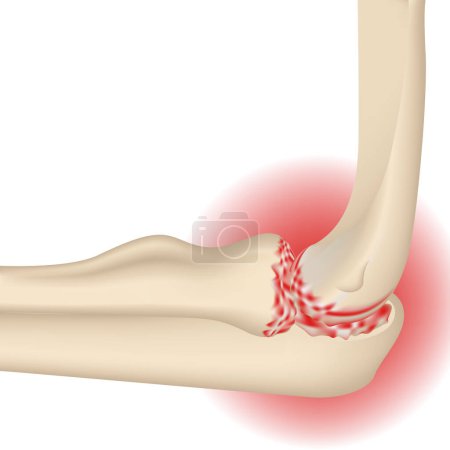 Artrosis de articulación del codo. Representación realista de huesos de la mano. Cartel médico. Ilustración vectorial aislada