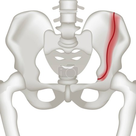 Illustration for Vertical frature of the human pelvic bone. Realistic rendering for medical design. Vector illustration - Royalty Free Image