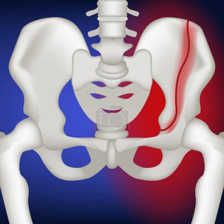 Vertikale Fraktur des Beckenknochens. 3D-Darstellung auf blauem Hintergrund. Medina-Vektorillustration