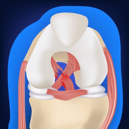 Kreuzbandriss im Knie. 3D-Darstellung auf blauem Hintergrund. Medina-Vektorillustration
