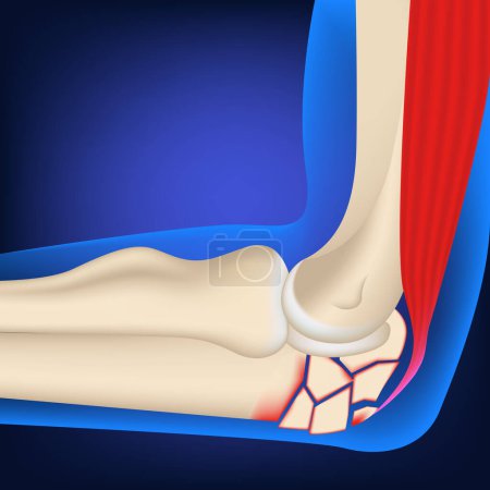 Comminuted fracture of the elbow joint. 3d rendering on a blue background. Medina vector illustration