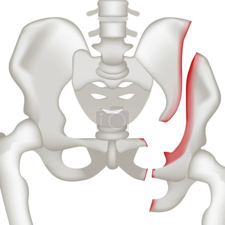 Bruch des Beckenknochens. Realistische Darstellung der menschlichen Anatomie. Medizinisches Poster, Vektorillustration