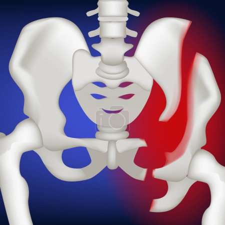 Menschlicher Beckenbruch auf einem blau leuchtenden Hintergrund. Realistische Darstellung der Knochen. Medizinisches Plakat. Vektorillustration