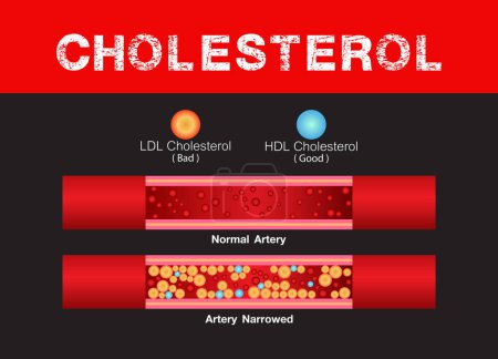 Téléchargez les illustrations : Cholesterol in artery, health risk , accumulation blood, Obesity, vector design - en licence libre de droit