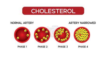 Ilustración de Colesterol en arteria, riesgo para la salud, HDL y LDL en arteria, Prueba de colestano - Imagen libre de derechos
