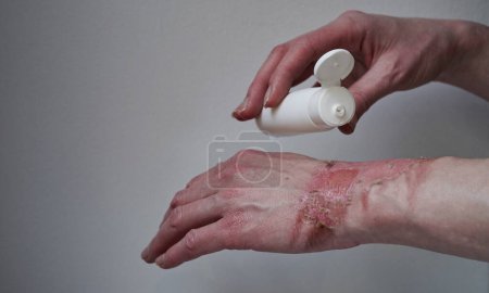 Mockup bottle with cream healing ointment woman hand burned with boiling water with burst blister,damaged skin,1st or 2nd degree burns.Painful wound.Thermal burn.skin flaky after burn