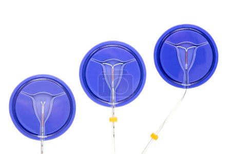 Installation der IUD in der Gebärmutter in 3 Phasen.