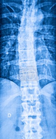 Téléchargez les photos : Radiographie de la colonne vertébrale atteinte de scoliose, vue frontale. - en image libre de droit