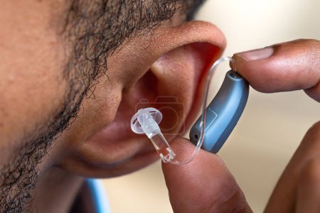 Close-up of the installation of the prosthesis in the ear of a young man.