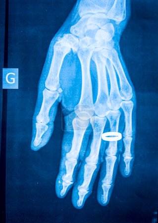 X-ray of rheumatism in the hands.