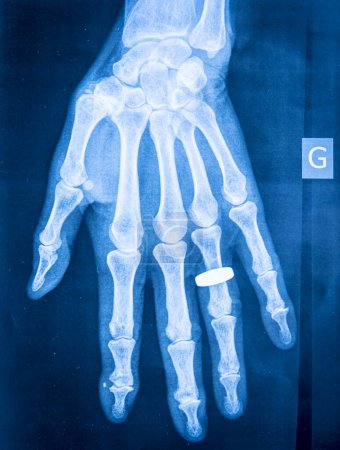 Radiographie de rhumatismes dans les mains.