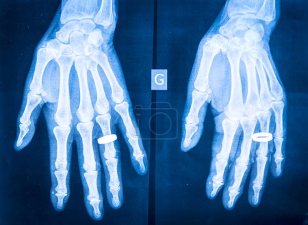 Photo for X-ray of rheumatism in the hands. - Royalty Free Image