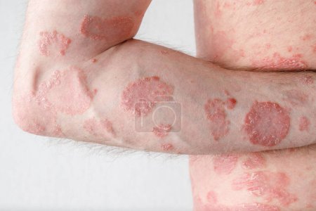 Papules of chronic psoriasis vulgaris on male hand and body on neutral background. Genetic immune disease.