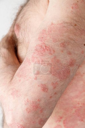 Papeln chronischer Psoriasis vulgaris auf männlicher Hand und Körper auf neutralem Hintergrund. Genetische Immunerkrankung.