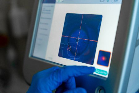 Écran utilisé par l'ophtalmologiste pour surveiller l'application du laser dans l'?il pendant le traitement du glaucome chez un patient