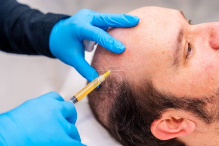 Dermatólogo inyectando sangre centrífuga en la cabeza del hombre para tratar la calvicie en un procedimiento innovador