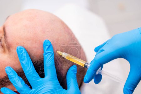 Close-up of the hands of a medical personnel applying a treatment against baldness using plasma injection as a treatment