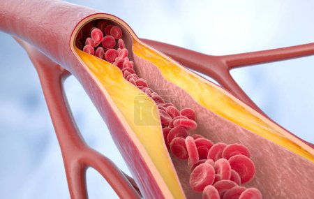 Atherosclerosis disease. Cholesterol in the blood vessels. atherosclerotic plaque, blood cells, blood pressure. 3D rendering. 3D illustration