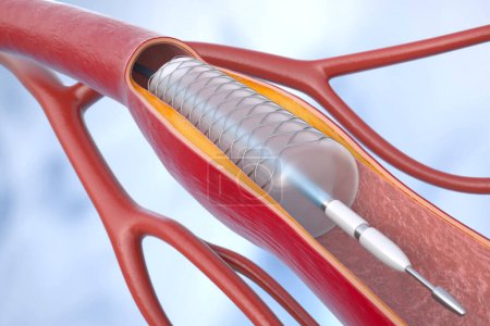 La angioplastia coronaria con stent (intervención coronaria percutánea o ICP) ayuda a mejorar el suministro de sangre al corazón. Ilustración 3D