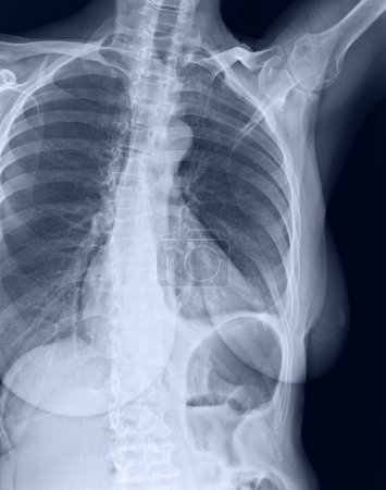 Foto de Radiografía costal de costa, esternón y clavícula que muestra una infracción de la octava costilla a la izquierda - Imagen libre de derechos